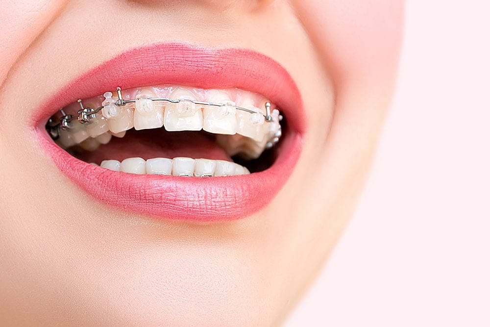Ceramic braces are a great option for orthodontic treatment. Are they right for you?
