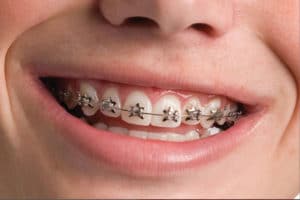 WildSmiles braces Smith Orthodontics in Parkersburg and Ripley, WV