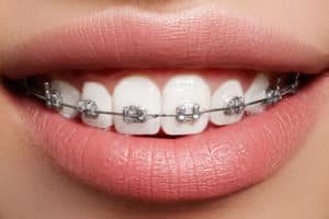 The different parts of braces pictured