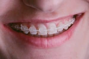 Want an invisible orthodontic treatment? Here's why you should consider ceramic braces in Parkersburg and Ripley WV
