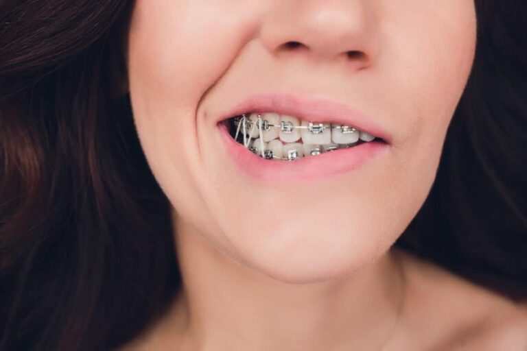 What Do The Rubber Bands On My Braces Really Do? Orthodontist Parkersburg Ripley WV Invisalign