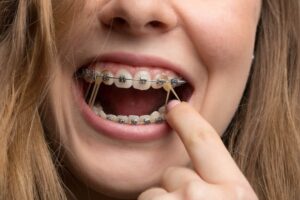 A misaligned bite can sometimes be fixed with braces in Parkersburg WV