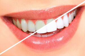 Getting whiter teeth with braces in Ripley WV