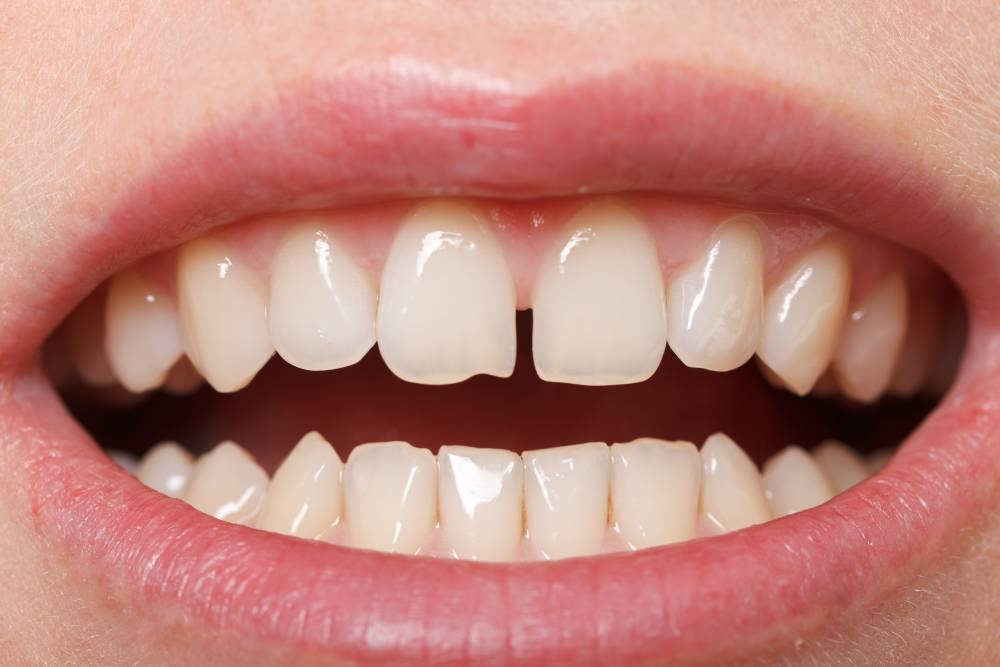 How the spacing of your teeth affects your dental health.