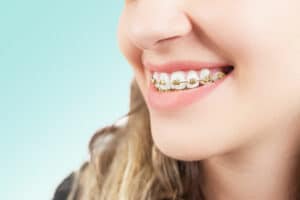 gold braces Smith Orthodontics in Parkersburg and Ripley, WV