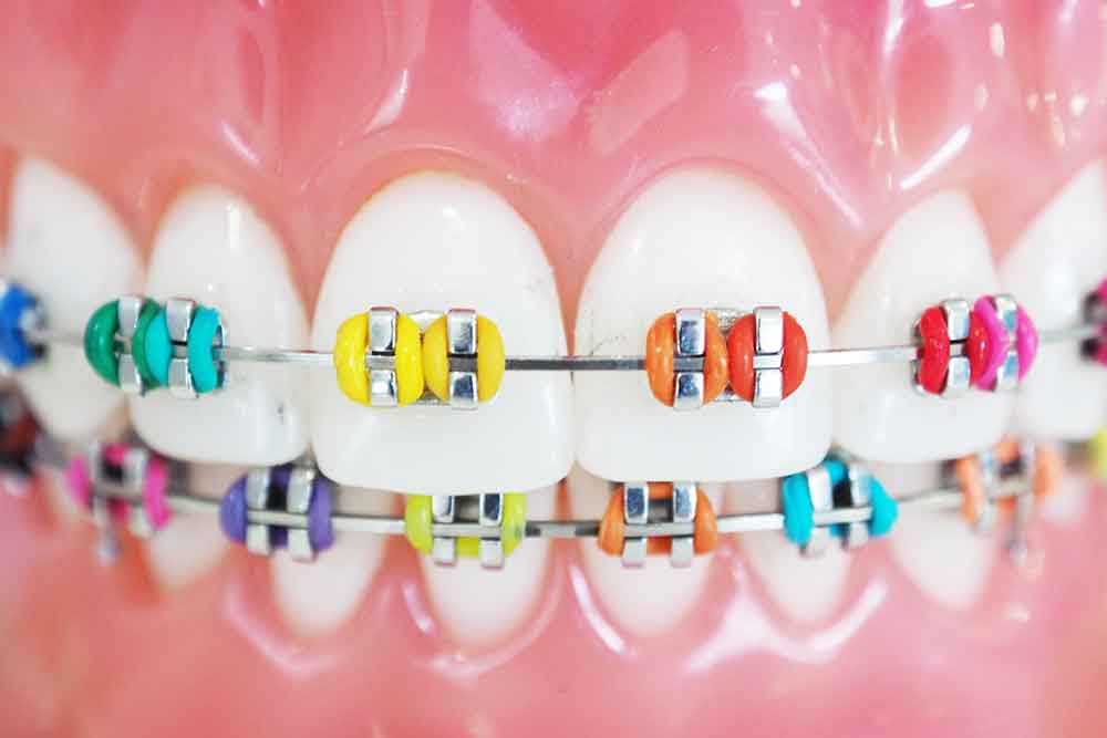 how to pick best braces colors Smith Orthodontics in Parkersburg and Ripley, WV
