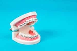 how much do braces cost Smith Orthodontics in Parkersburg and Ripley, WV