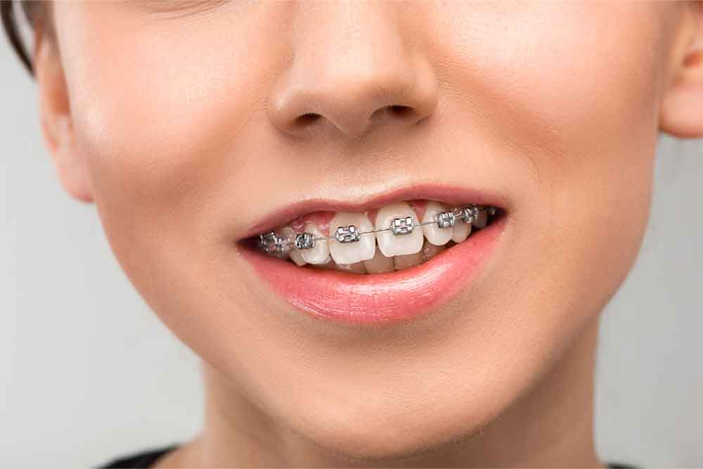 fix an overbite Smith Orthodontics in Parkersburg and Ripley, WV