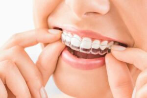 how long does invisalign take Smith Orthodontics in Parkersburg and Ripley, WV.